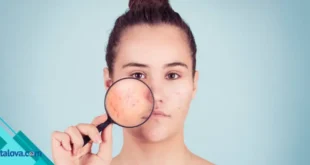 Cara Menghilangkan Bekas Jerawat Hitam di Pipi